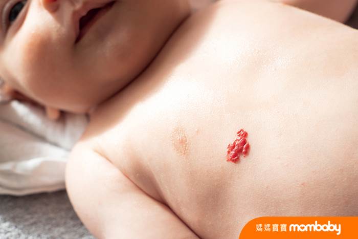 嬰兒血管瘤