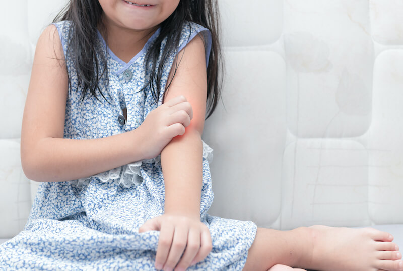 兒童蕁麻疹|兒童肌膚照顧|急性蕁麻疹 |慢性蕁麻疹