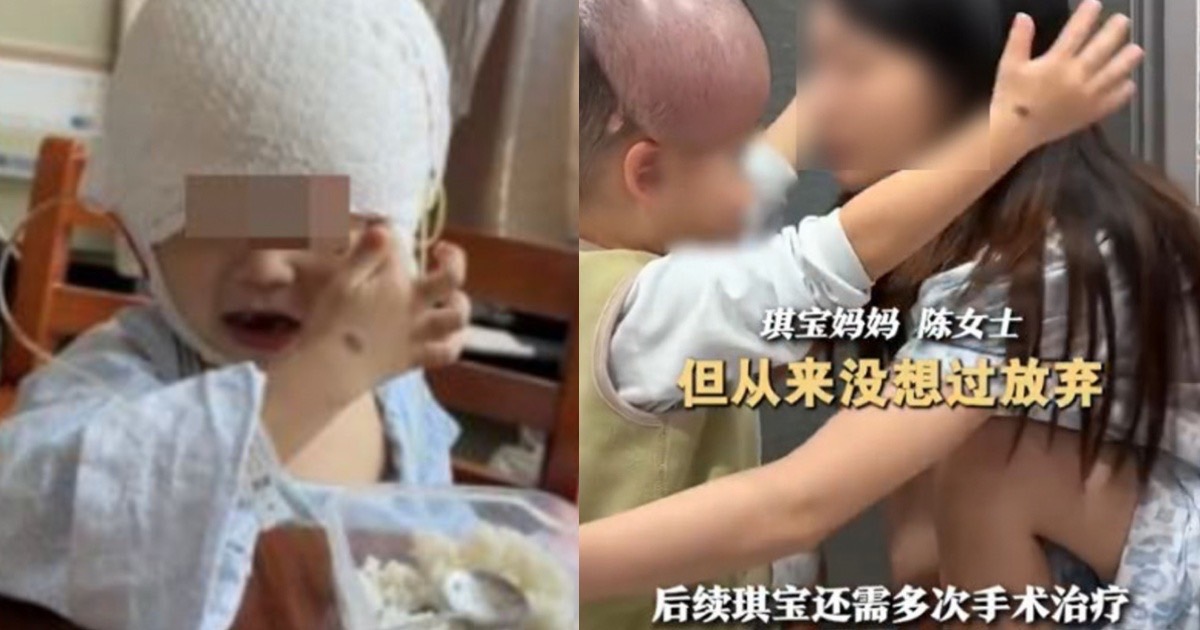 黑痣|整形|米老鼠