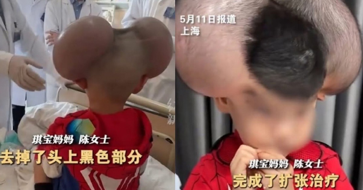 黑痣|整形|米老鼠