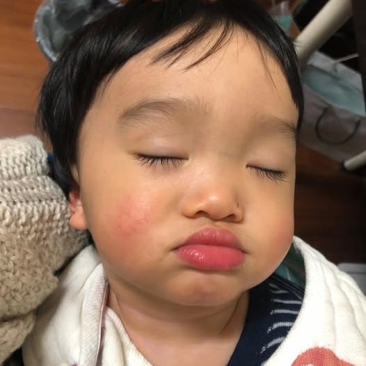 紅疹|蘋果臉|孩子|冬季|冬天|環境乾燥|乾癢|抓|缺脂性皮膚炎|兒科醫師