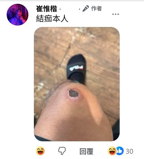 結痂本人!
