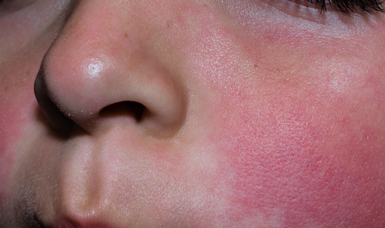 B19微小病毒│蘋果病