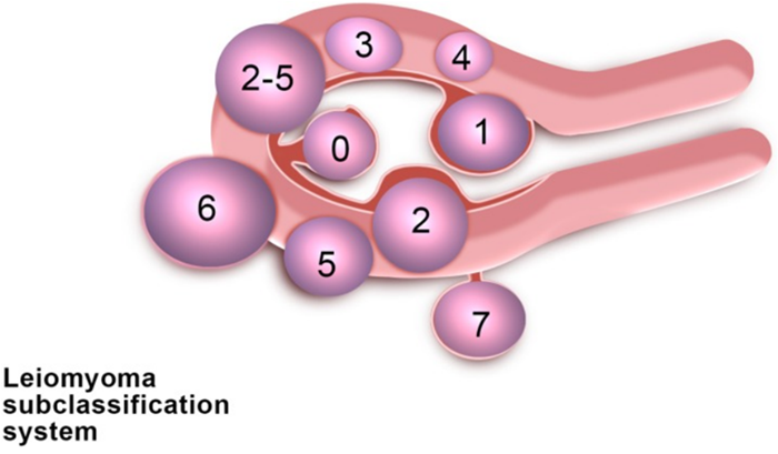 子宮肌瘤分型圖