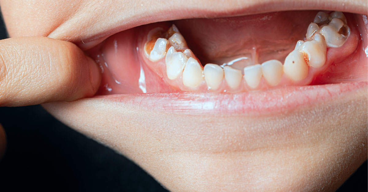 氟化物|兒童牙膏|蛀牙