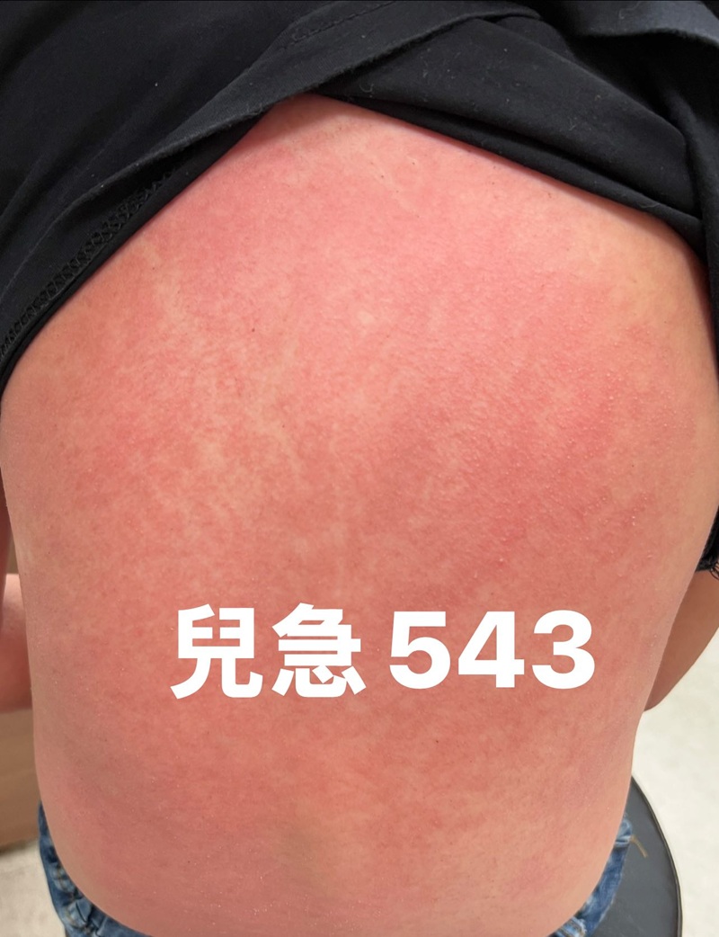 A型鏈球菌|猩紅熱|兒科急診|兒科醫師|夏季|流行病毒|疫情|紅疹|皮疹