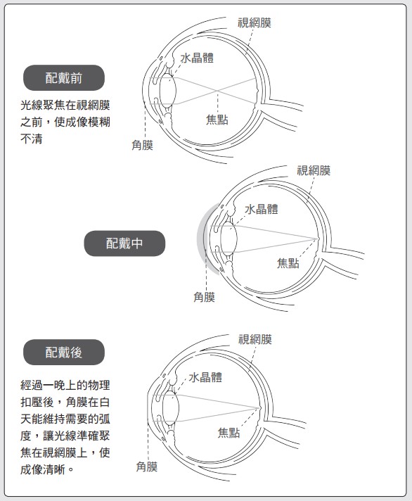 角膜塑形片