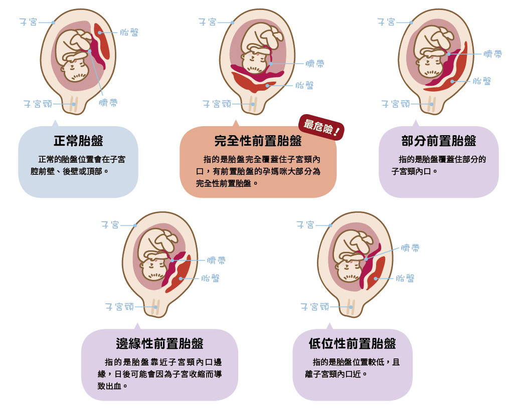 孕期｜胎盤