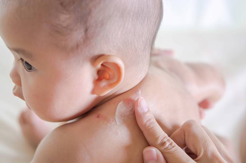 嬰兒肌膚｜嬰兒皮膚炎｜嬰兒濕疹｜寶寶濕疹