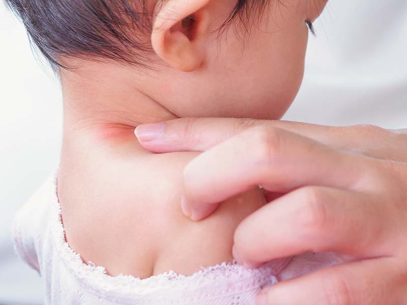 兒童蕁麻疹|兒童肌膚照顧|急性蕁麻疹 |慢性蕁麻疹
