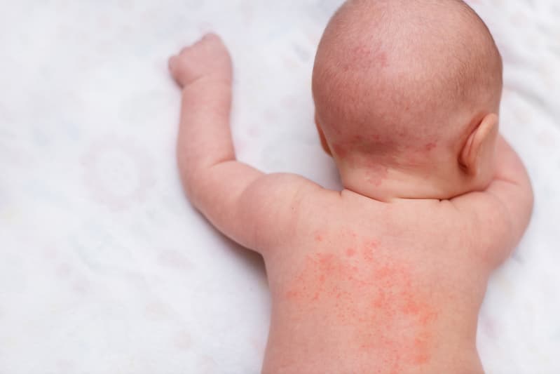 嬰幼兒皮膚問題｜脂漏性皮膚炎｜異位性皮膚炎