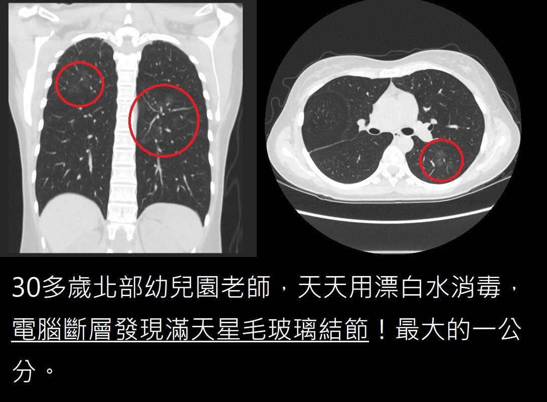 肺結節│漂白水
